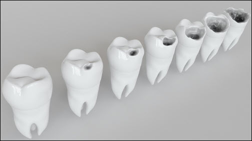 Cavities