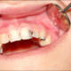 Cavities