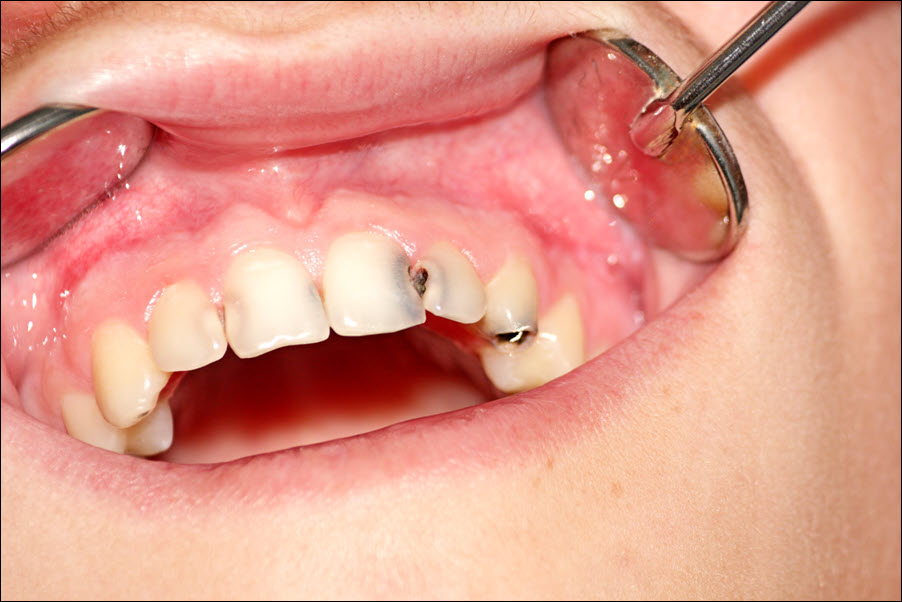 Cavities