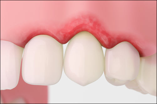 Dental Cleaning