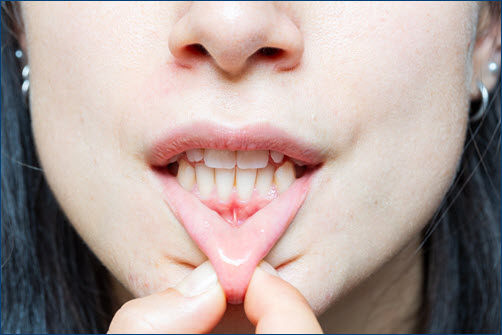 Gum Recession