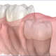 Impacted Teeth