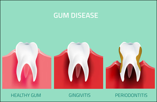 gum disease